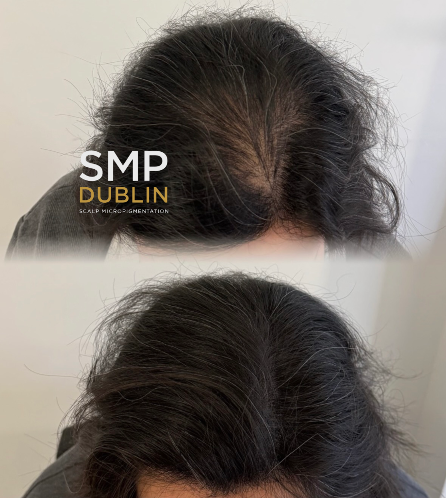 When you click on density procedures: smp dublin