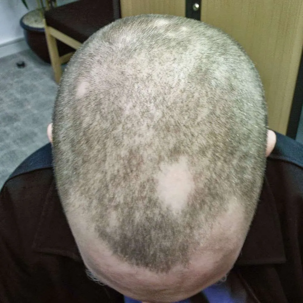 Alopecia small 4: smp dublin