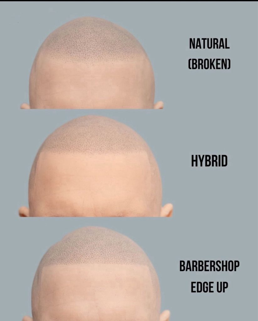 Hairline options: smp dublin